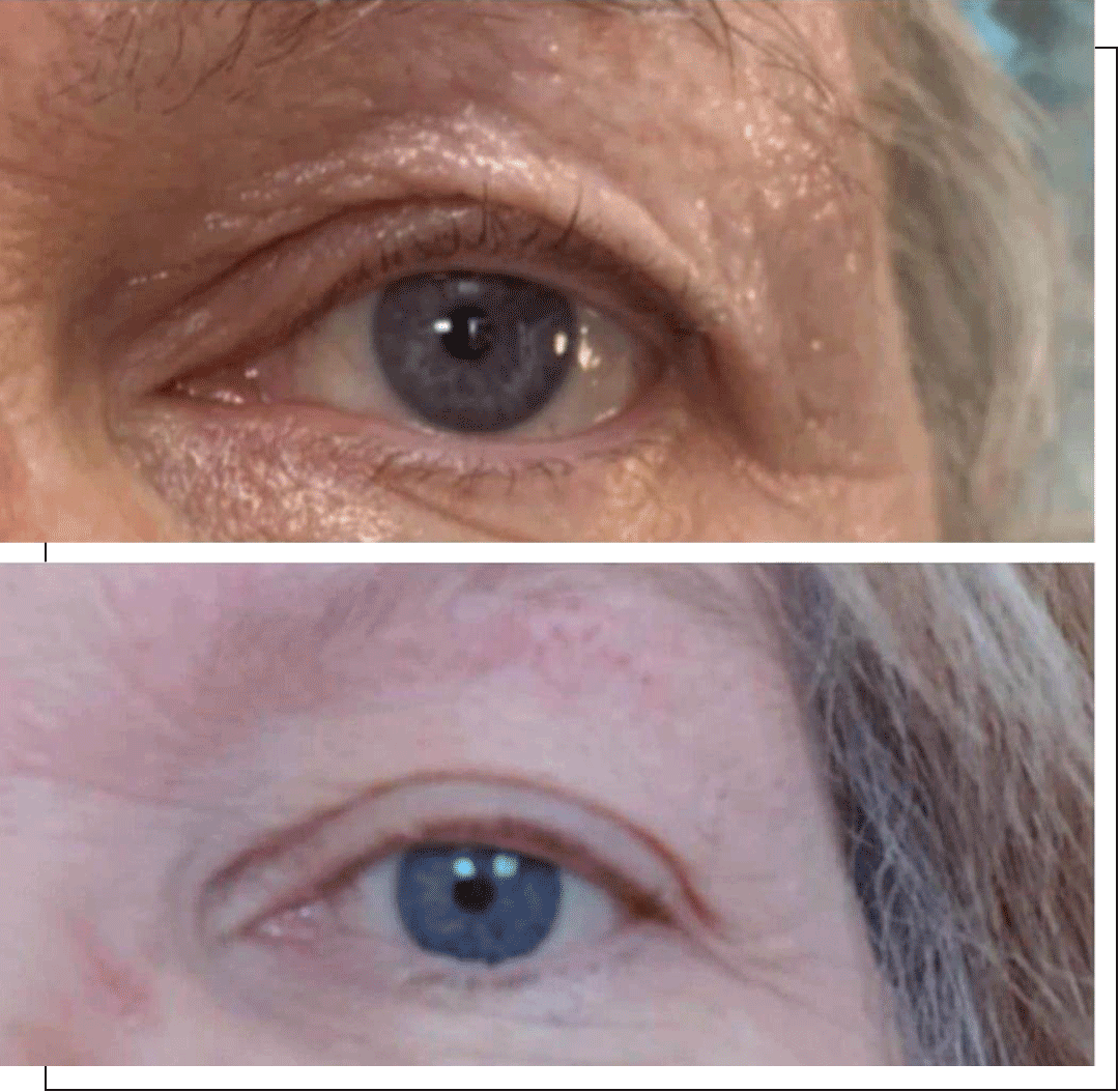 Before and after fibroblasting, Beauty, Fibroblasting